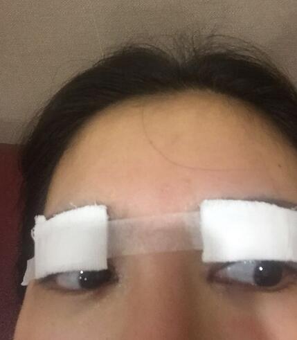 雙眼皮+開眼角3個月恢復過程圖