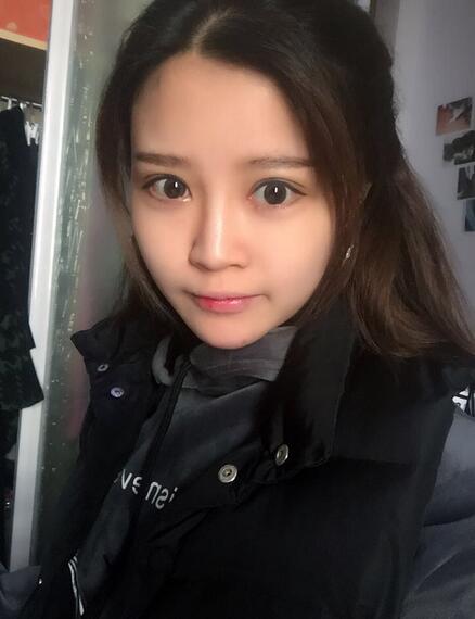 雙眼皮+開眼角3個月恢復過程圖