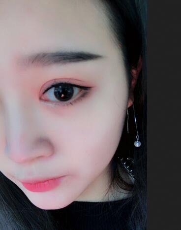 雙眼皮+開眼角3個月恢復過程圖