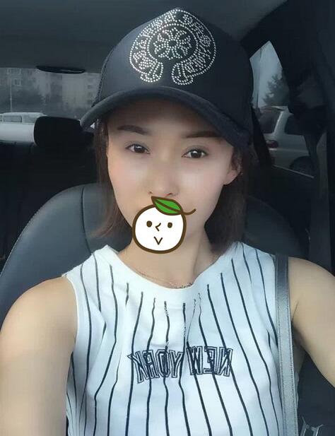 北京麗星雙眼皮修復(fù)半年了