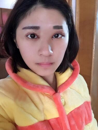 微創(chuàng)定點(diǎn)每天恢復(fù)過程圖 北京麗星雙眼皮3個月