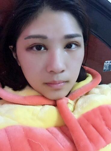 微創(chuàng)定點(diǎn)每天恢復(fù)過程圖 北京麗星雙眼皮3個月