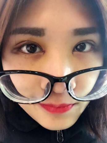 微創(chuàng)定點(diǎn)每天恢復(fù)過程圖 北京麗星雙眼皮3個月