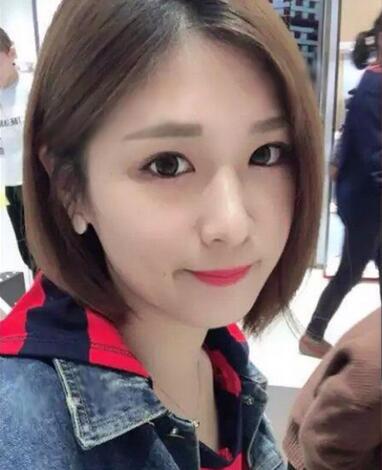 微創(chuàng)定點(diǎn)每天恢復(fù)過程圖 北京麗星雙眼皮3個月