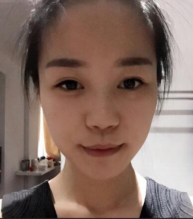 硅膠隆鼻前后對比 硅膠隆鼻+鼻小柱延長恢復(fù)日記