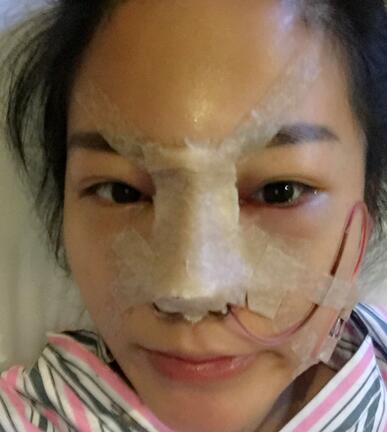 硅膠隆鼻前后對比 硅膠隆鼻+鼻小柱延長恢復(fù)日記