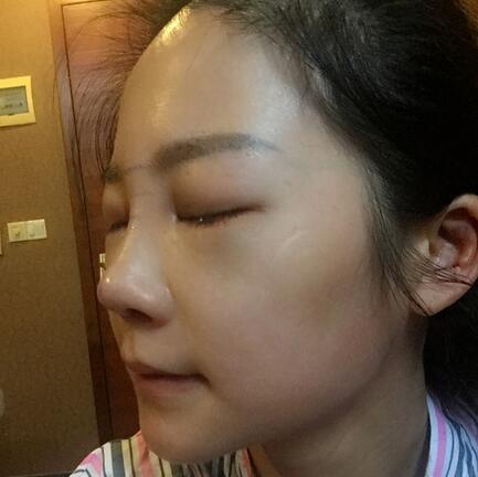 硅膠隆鼻前后對比 硅膠隆鼻+鼻小柱延長恢復(fù)日記