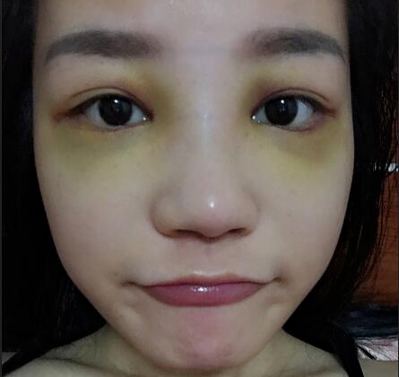 硅膠隆鼻前后對比 硅膠隆鼻+鼻小柱延長恢復(fù)日記