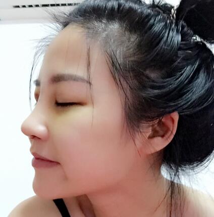 硅膠隆鼻前后對比 硅膠隆鼻+鼻小柱延長恢復(fù)日記