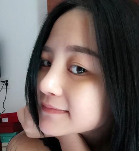 硅膠隆鼻前后對比 硅膠隆鼻+鼻小柱延長恢復(fù)日記