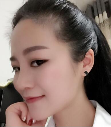 硅膠隆鼻前后對比 硅膠隆鼻+鼻小柱延長恢復(fù)日記