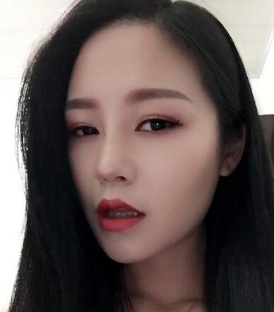 硅膠隆鼻前后對比 硅膠隆鼻+鼻小柱延長恢復(fù)日記