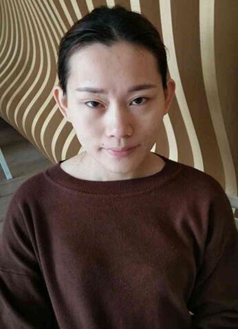 詳細(xì)部脂肪填充果圖 術(shù)后恢復(fù)分享