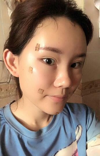 詳細(xì)部脂肪填充果圖 術(shù)后恢復(fù)分享