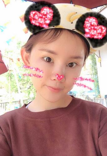 詳細(xì)部脂肪填充果圖 術(shù)后恢復(fù)分享