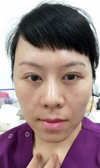 面部埋埋蛋白線.提升恢復(fù)過(guò)程分享