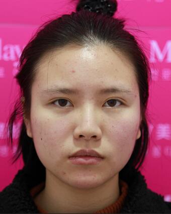 耳軟骨墊鼻尖一個(gè)月圖