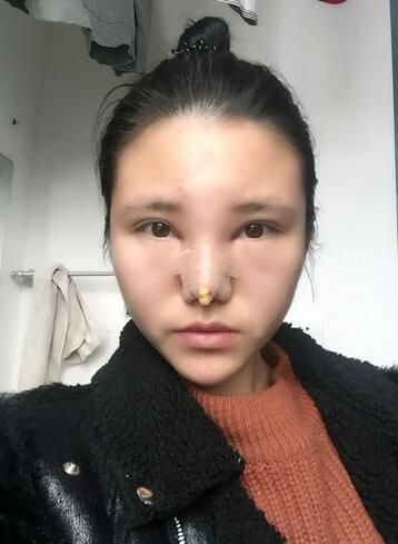 耳軟骨墊鼻尖一個(gè)月圖