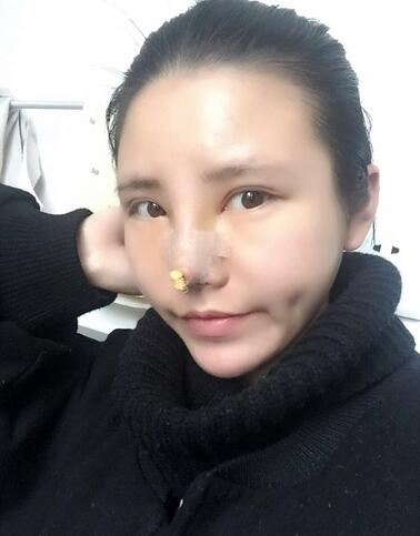 耳軟骨墊鼻尖一個(gè)月圖