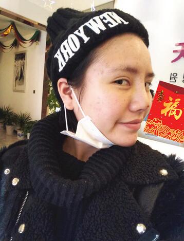 耳軟骨墊鼻尖一個(gè)月圖