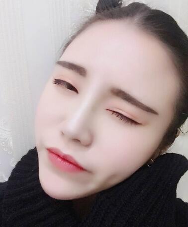 耳軟骨墊鼻尖一個(gè)月圖