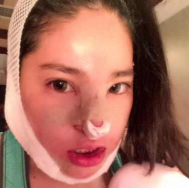 隆鼻整形2個(gè)月恢復(fù)日記 硅膠隆鼻+鼻翼縮小