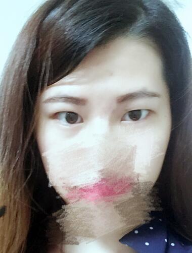 切開(kāi)重瞼術(shù)恢復(fù)過(guò)程圖