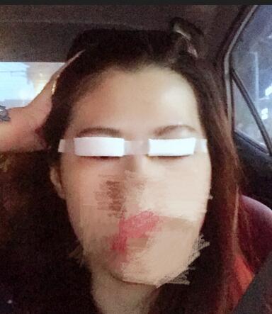 切開(kāi)重瞼術(shù)恢復(fù)過(guò)程圖