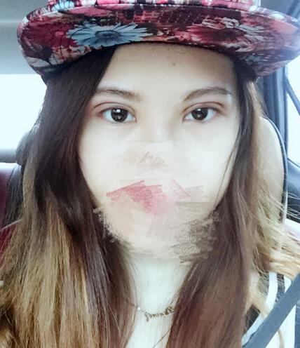 切開(kāi)重瞼術(shù)恢復(fù)過(guò)程圖