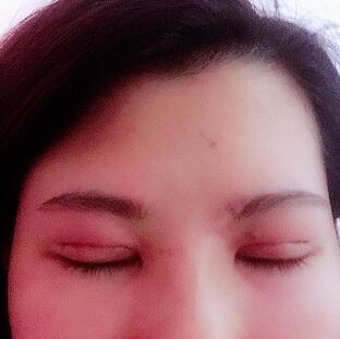 切開(kāi)重瞼術(shù)恢復(fù)過(guò)程圖