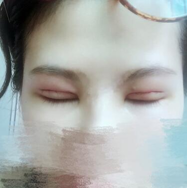 切開(kāi)重瞼術(shù)恢復(fù)過(guò)程圖