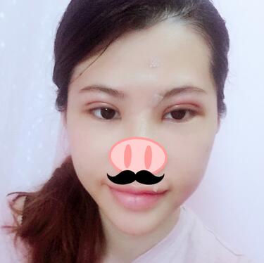 切開(kāi)重瞼術(shù)恢復(fù)過(guò)程圖