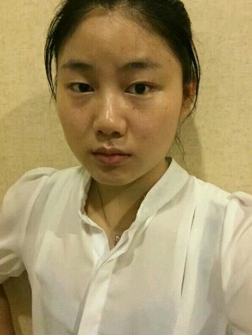 全切雙眼皮半年恢復(fù)過(guò)程圖