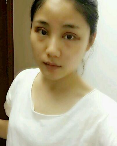 全切雙眼皮半年恢復(fù)過(guò)程圖