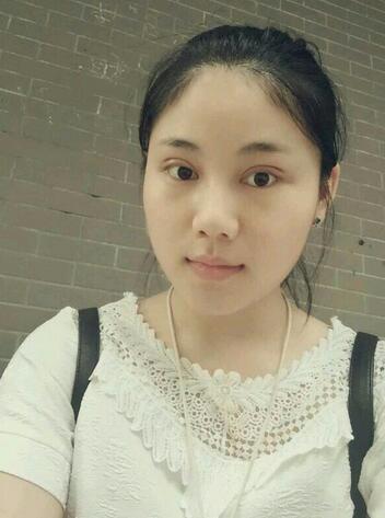 全切雙眼皮半年恢復(fù)過(guò)程圖