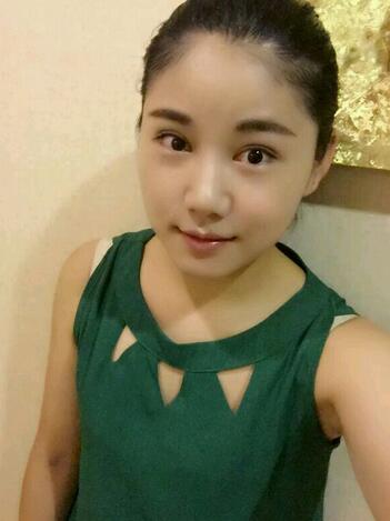 全切雙眼皮半年恢復(fù)過(guò)程圖