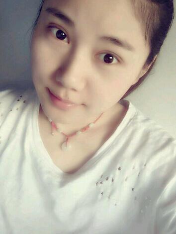 全切雙眼皮半年恢復(fù)過(guò)程圖