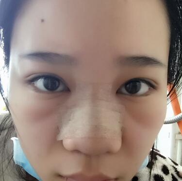 隆鼻拆線后鼻子圖片 硅膠隆鼻+鼻翼縮小恢復經(jīng)歷