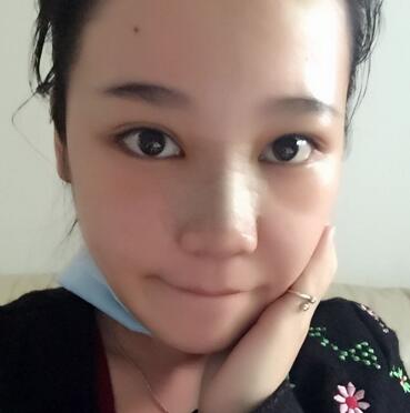 隆鼻拆線后鼻子圖片 硅膠隆鼻+鼻翼縮小恢復經(jīng)歷