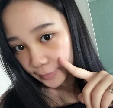 隆鼻拆線后鼻子圖片 硅膠隆鼻+鼻翼縮小恢復經(jīng)歷