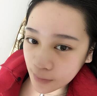 隆鼻拆線后鼻子圖片 硅膠隆鼻+鼻翼縮小恢復經(jīng)歷