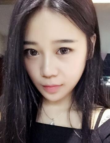 隆鼻拆線后鼻子圖片 硅膠隆鼻+鼻翼縮小恢復經(jīng)歷