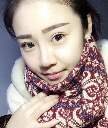 耳軟骨墊鼻尖三個(gè)月圖 耳軟骨墊鼻尖+硅膠隆鼻