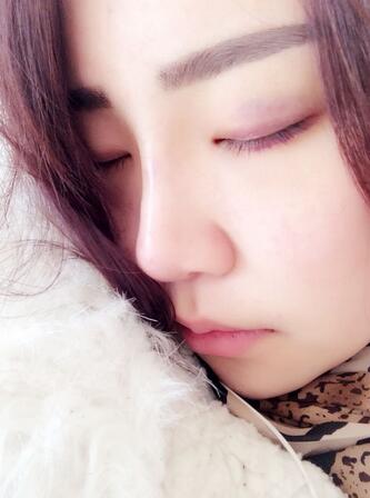 耳軟骨墊鼻尖三個(gè)月圖 耳軟骨墊鼻尖+硅膠隆鼻