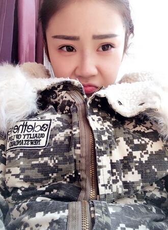 耳軟骨墊鼻尖三個(gè)月圖 耳軟骨墊鼻尖+硅膠隆鼻