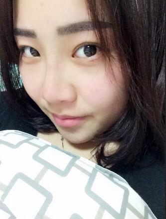 耳軟骨墊鼻尖三個(gè)月圖 耳軟骨墊鼻尖+硅膠隆鼻