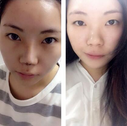 隆鼻整形真實(shí)恢復(fù)期圖片 硅膠隆鼻+鼻頭縮小