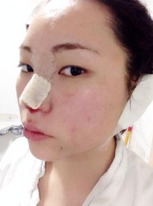 隆鼻整形真實(shí)恢復(fù)期圖片 硅膠隆鼻+鼻頭縮小