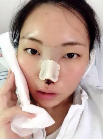 隆鼻整形真實(shí)恢復(fù)期圖片 硅膠隆鼻+鼻頭縮小