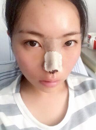 隆鼻整形真實(shí)恢復(fù)期圖片 硅膠隆鼻+鼻頭縮小